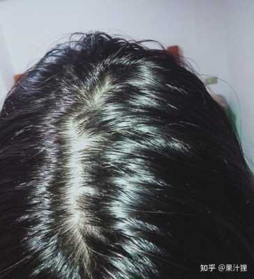 为什么头发特别容易油（为什么头发特别容易油还痒）