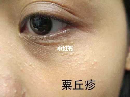 闭合性脂肪粒怎么消除（泡沫粒如何清理）