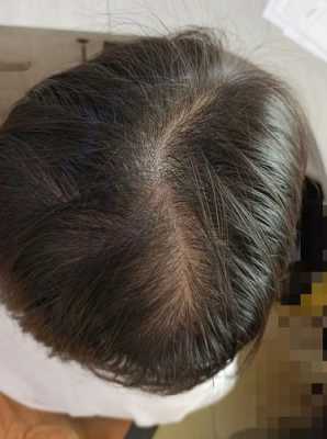 狗狗毛囊坏死怎么治,头发毛囊坏死有什么办法恢复吗
