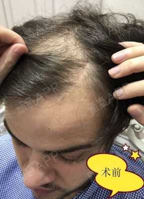 狗狗毛囊坏死怎么治,头发毛囊坏死有什么办法恢复吗