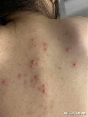 熬夜长痘痘怎么消除,熬夜背上长痘痘怎么办啊
