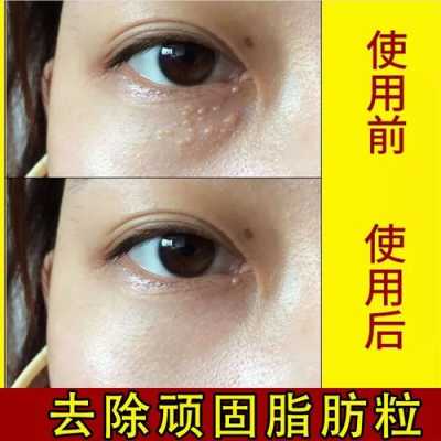 眼部脂肪粒怎么祛除,眼底脂肪粒怎么形成的呢