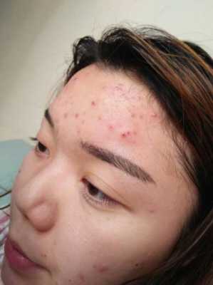 脸上长痘痘怎么治啊（脸上长痘痘怎么治啊?）