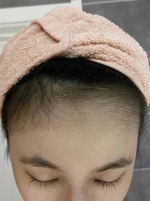额头上有毛发怎么办（额头上有毛发怎么办小妙招）