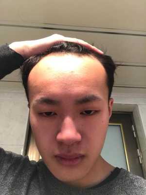额头没头发剪什么发型（前额秃适合的发型）