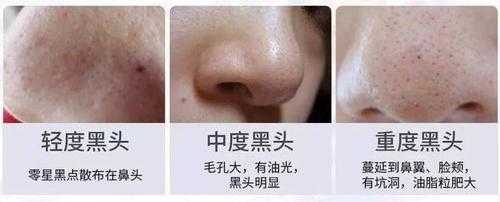 男士脸部毛孔粗大黑头怎么解决,男士毛孔粗有黑头怎么办呢