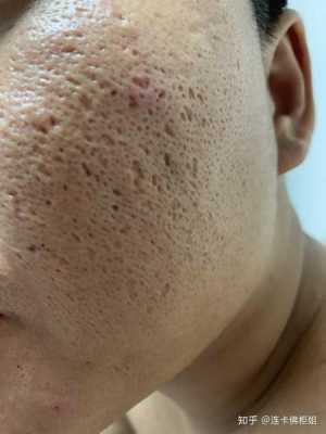 男士脸部毛孔粗大黑头怎么解决,男士毛孔粗有黑头怎么办呢