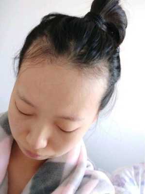 额头前头发少怎么办（额头前头发少怎么办女）