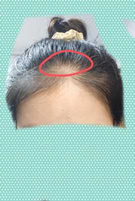 额头前头发少怎么办（额头前头发少怎么办女）