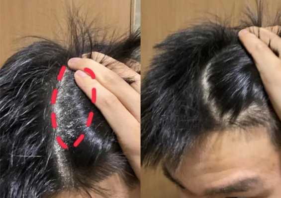 男士头皮屑太多怎么办（男士头皮屑太多怎么办啊）