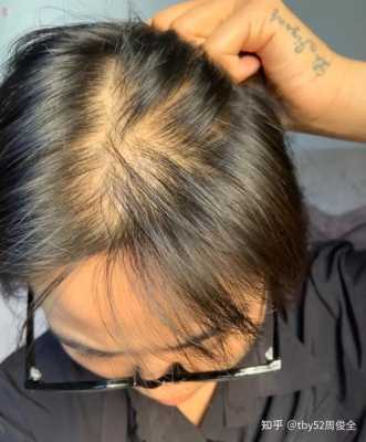 头顶头发稀少怎么办好呢（头顶头发稀少怎么办好呢女生）