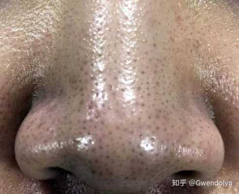 鼻子上有黑头怎么办小窍门（鼻子上有黑头怎么办小窍门图片）