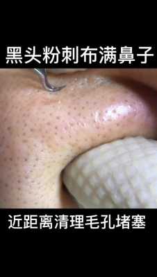 鼻子上有黑头怎么办小窍门（鼻子上有黑头怎么办小窍门图片）