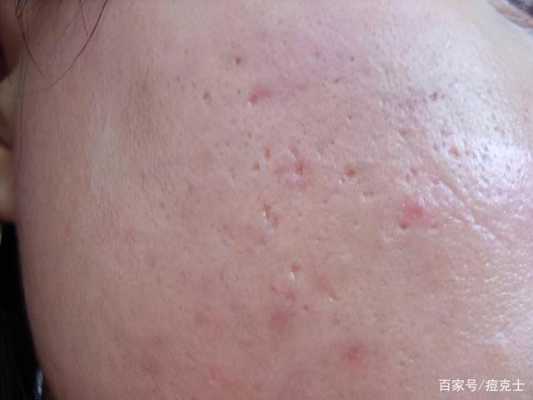 除痘印痘疤的最有效的方法是什么,怎么去痘疤痘印最有效的方法