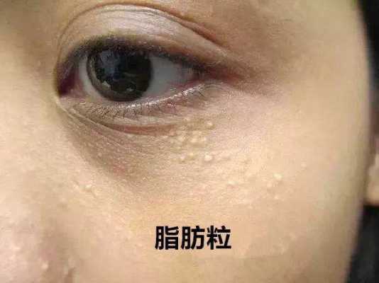 皮下油脂粒怎么去除,美容院去脂肪粒多少钱