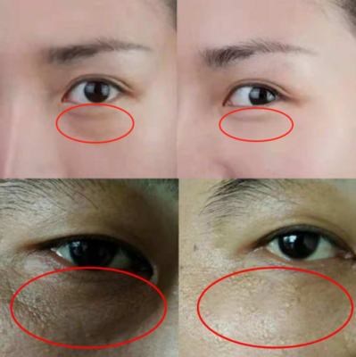 皮下油脂粒怎么去除,美容院去脂肪粒多少钱