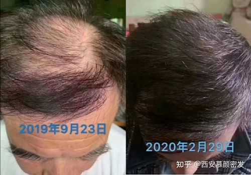 年轻人头顶脱发怎么办（年轻人脱发怎么治疗最有效果呢）