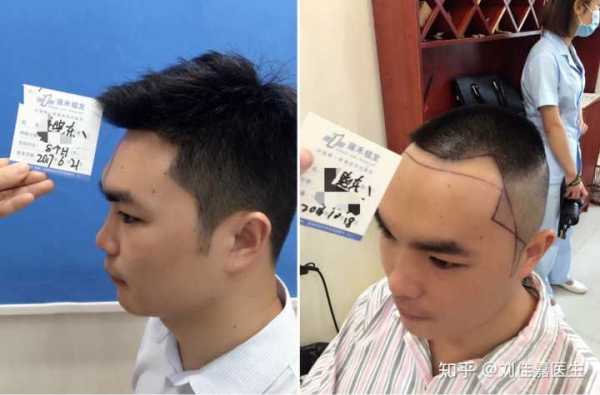 两边发际线太高适合什么发型,发际线两边高怎么办怎么解决