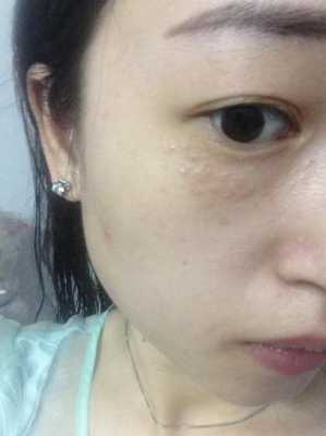脸上长脂肪粒怎么办,脸总是长脂肪粒