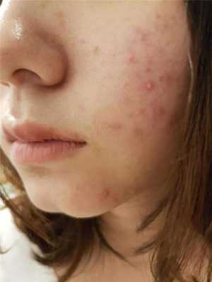 脸上长了很多痘痘，还是发脓的痘痘，可以吃阿莫西林的吗,脸上长痤疮的治疗法