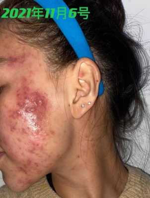 脸上长了很多痘痘，还是发脓的痘痘，可以吃阿莫西林的吗,脸上长痤疮的治疗法