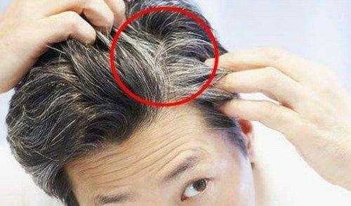 两边白头发多是怎么回事（两边白头发多是肾虚吗）