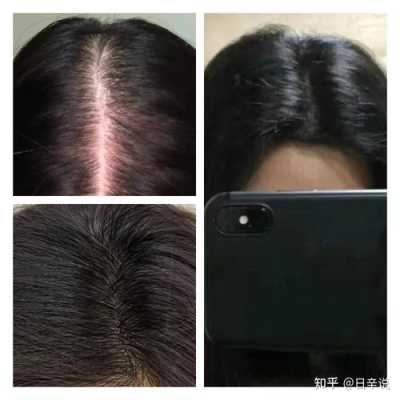 脱发怎么护理（脱发怎么回事）