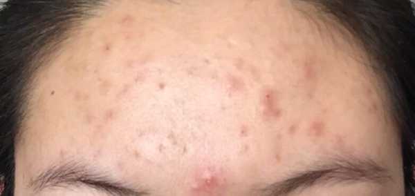 额头痘痘如何消除,额头痘怎么去除小窍门