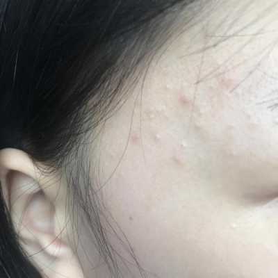 额头痘痘如何消除,额头痘怎么去除小窍门