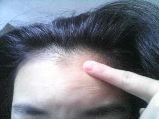 额头痘痘如何消除,额头痘怎么去除小窍门