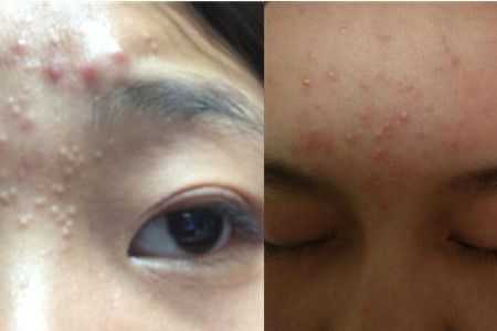 长痘痘了怎么消除,眉毛上面长痘怎么消除
