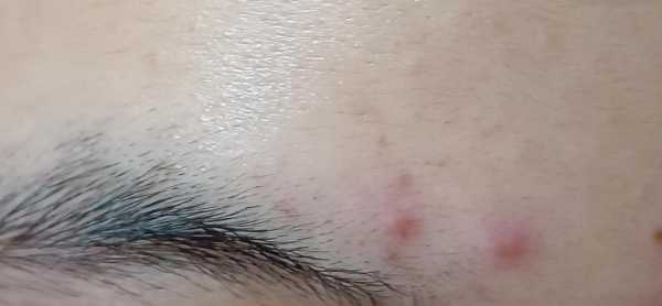 长痘痘了怎么消除,眉毛上面长痘怎么消除
