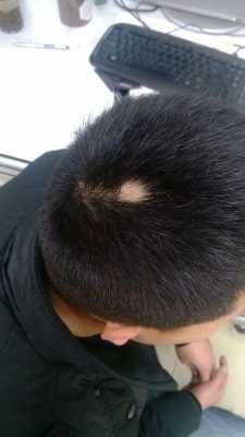 后脑勺头发突然秃了一块,是怎么回事,头发为什么会斑秃的原因