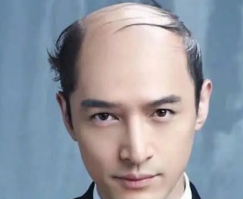 地中海留什么发型好看（轻微地中海剪什么发型）