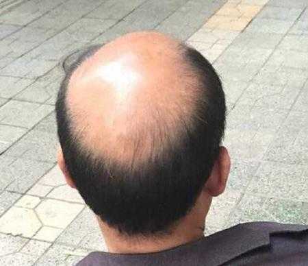 头发干掉发是什么原因（永久大光头怎么脱头发）