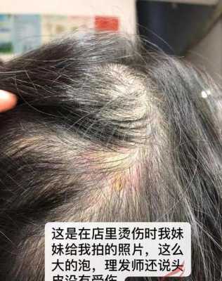 烫发烫伤了怎么处理（烫发烫伤了怎么办）