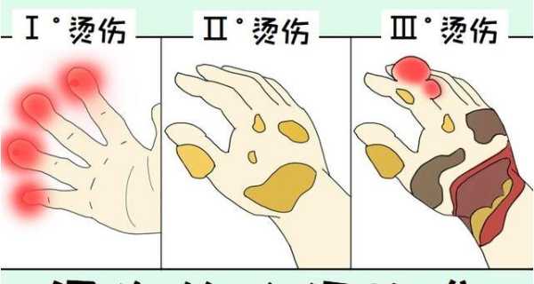 烫发烫伤了怎么处理（烫发烫伤了怎么办）