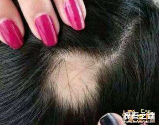 脱头发与什么病有关系（脱头发与什么病有关系）