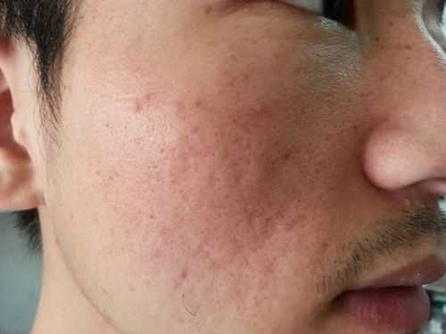 为什么脸上的毛孔张开了,脸上毛孔多是什么原因引起