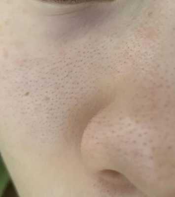 为什么脸上的毛孔张开了,脸上毛孔多是什么原因引起