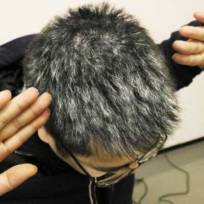 少年有白发是什么原因（少年有白发是什么原因引起的）