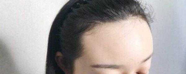 怎么预防发际线后移（保护发际线的方法）