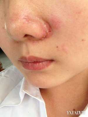 鼻子起疙瘩是什么原因（鼻子起疙瘩是什么原因造成的）