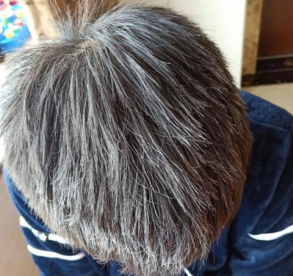 有什么办法治白头发（有什么办法治白头发是最好的）