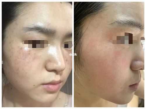 什么方法去斑快不反弹（什么方法去斑快不反弹呢）