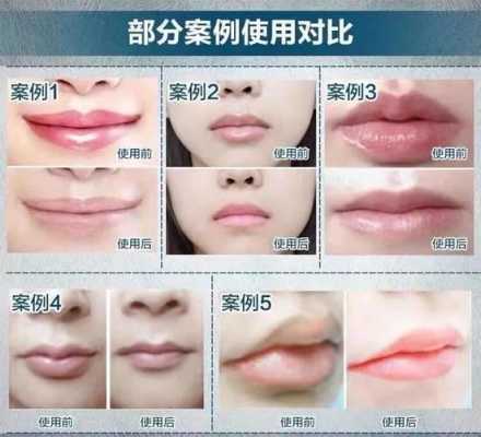 唇纹淡化方法,唇纹怎么改善医美方法