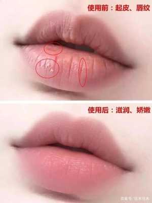 唇纹淡化方法,唇纹怎么改善医美方法