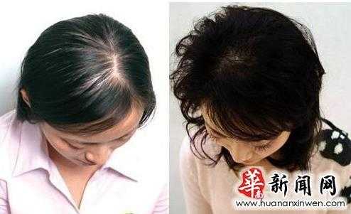 掉头发是什么引起的（掉头发是什么引起的原因女性）