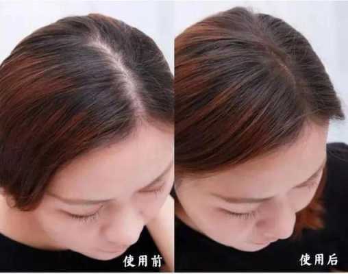 很多短头发怎么办（头发发根短，而且头发很细，出油厉害,怎样预防和治疗脱发）