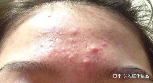 额头痘怎么去除小窍门（额头痘怎么去除小窍门图片）